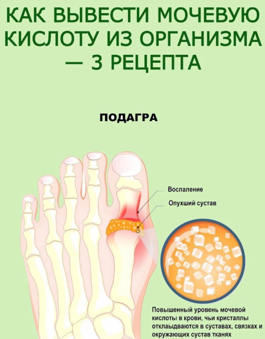 Вывод мочевой кислоты из организма. Вывод мочевой кислоты из суставов. Как вывести мочевую кислоту из организма и суставов. Народные средства выведения мочевой кислоты.