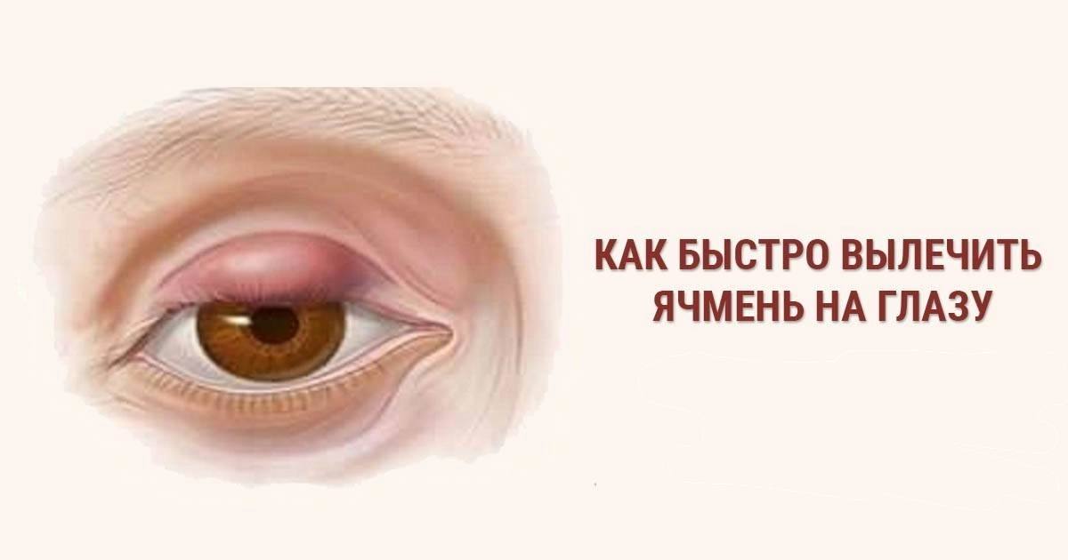Лечение ячменя на глазу. Как вылечить ячмень на глазу. Как быстро вылечить ячмень на глазу. Ячмень на глазу стадии развития.