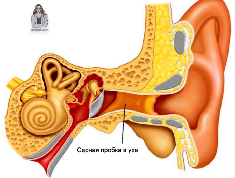 Пробка в ухе что сделать. Тубоотит барабанная перепонка. Наружный слуховой проход серная пробка. Наружный отит серная пробка.